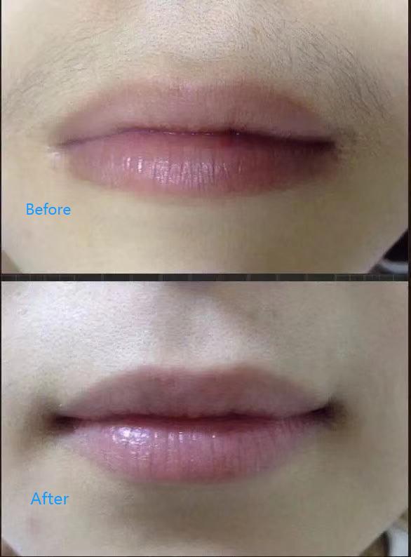 Laser Treatment at Life Holistics North East