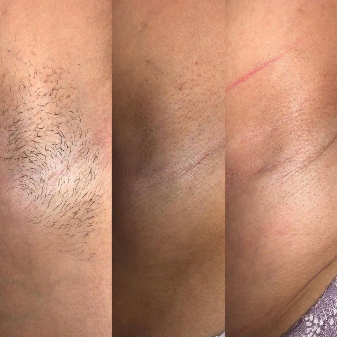 Laser Treatment at Life Holistics North East