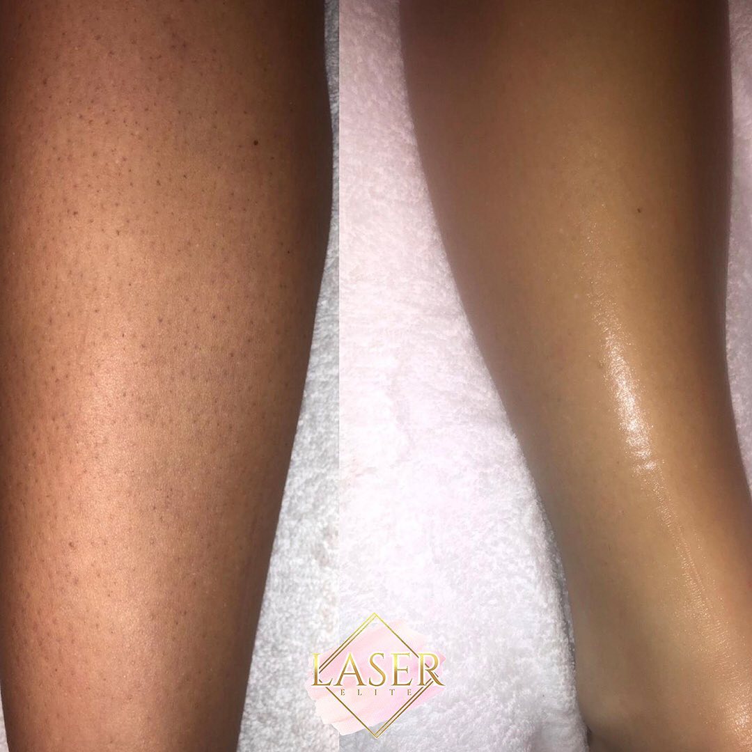 Laser Treatment at Life Holistics North East