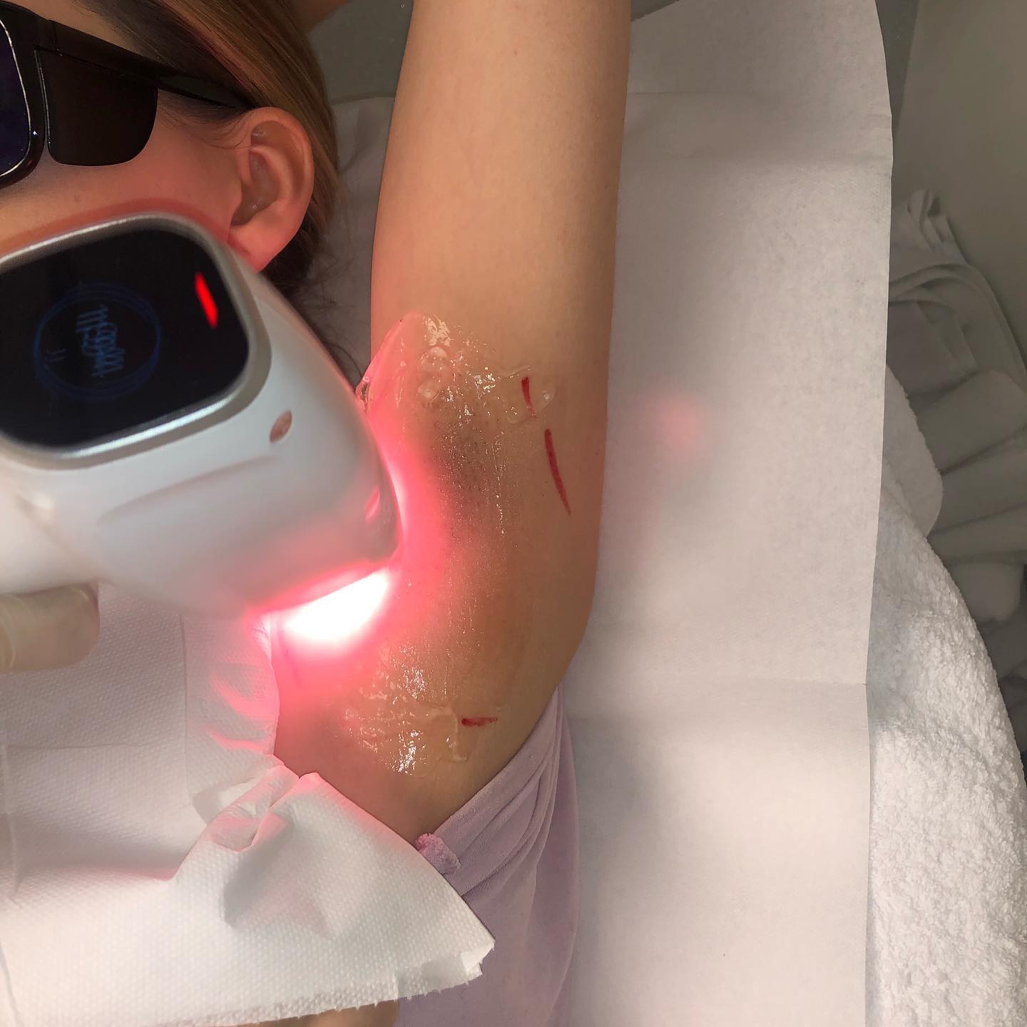 Laser Treatment at Life Holistics North East