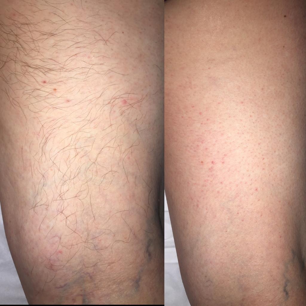 Arm Laser Treatment at Life Holistics North East