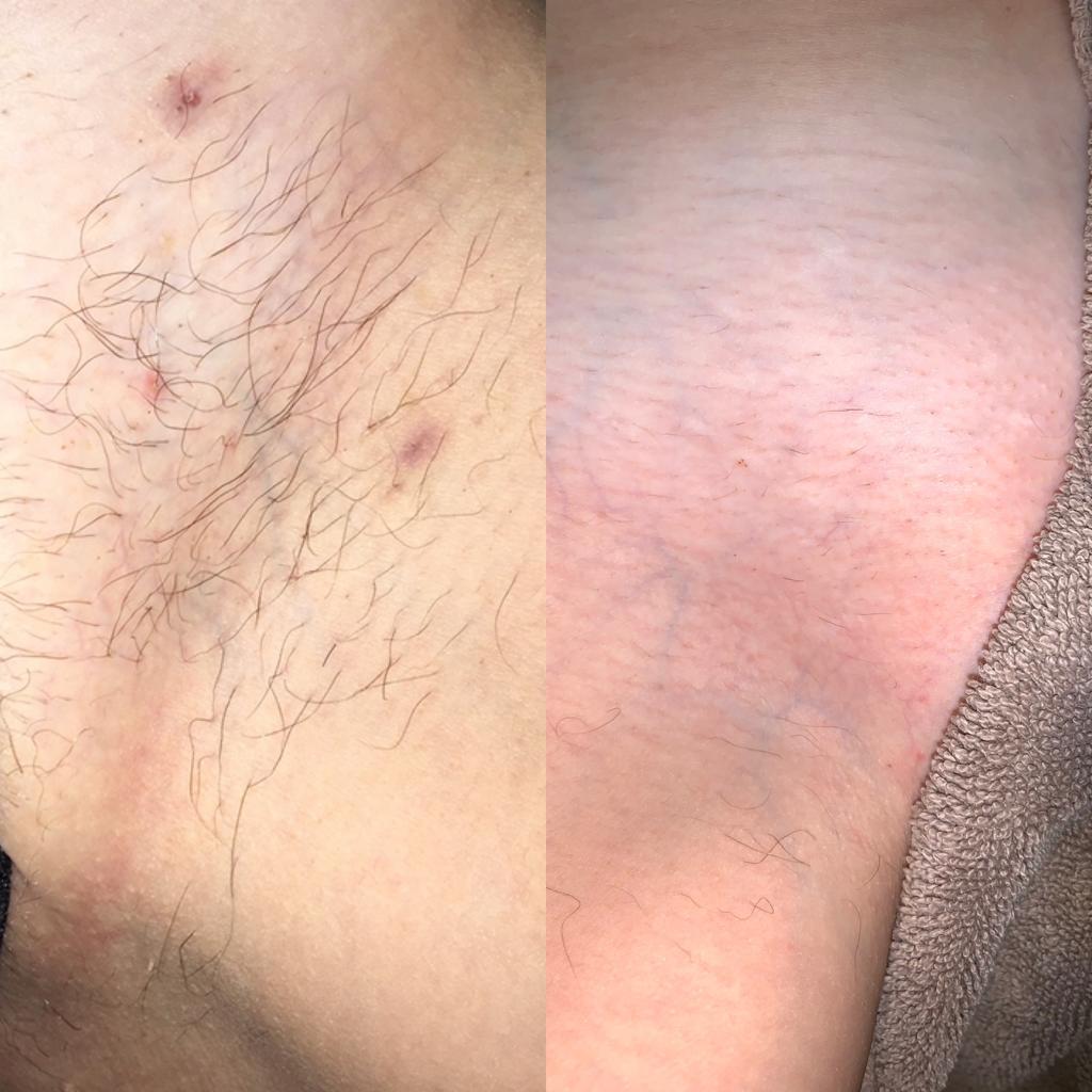 Bikini Laser Treatment at Life Holistics North East