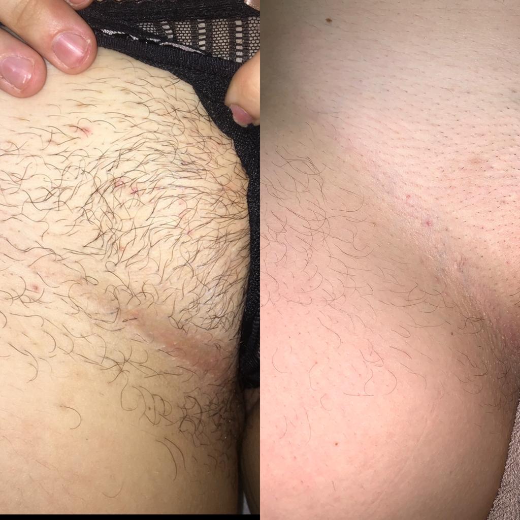 Bikini Laser Treatment at Life Holistics North East