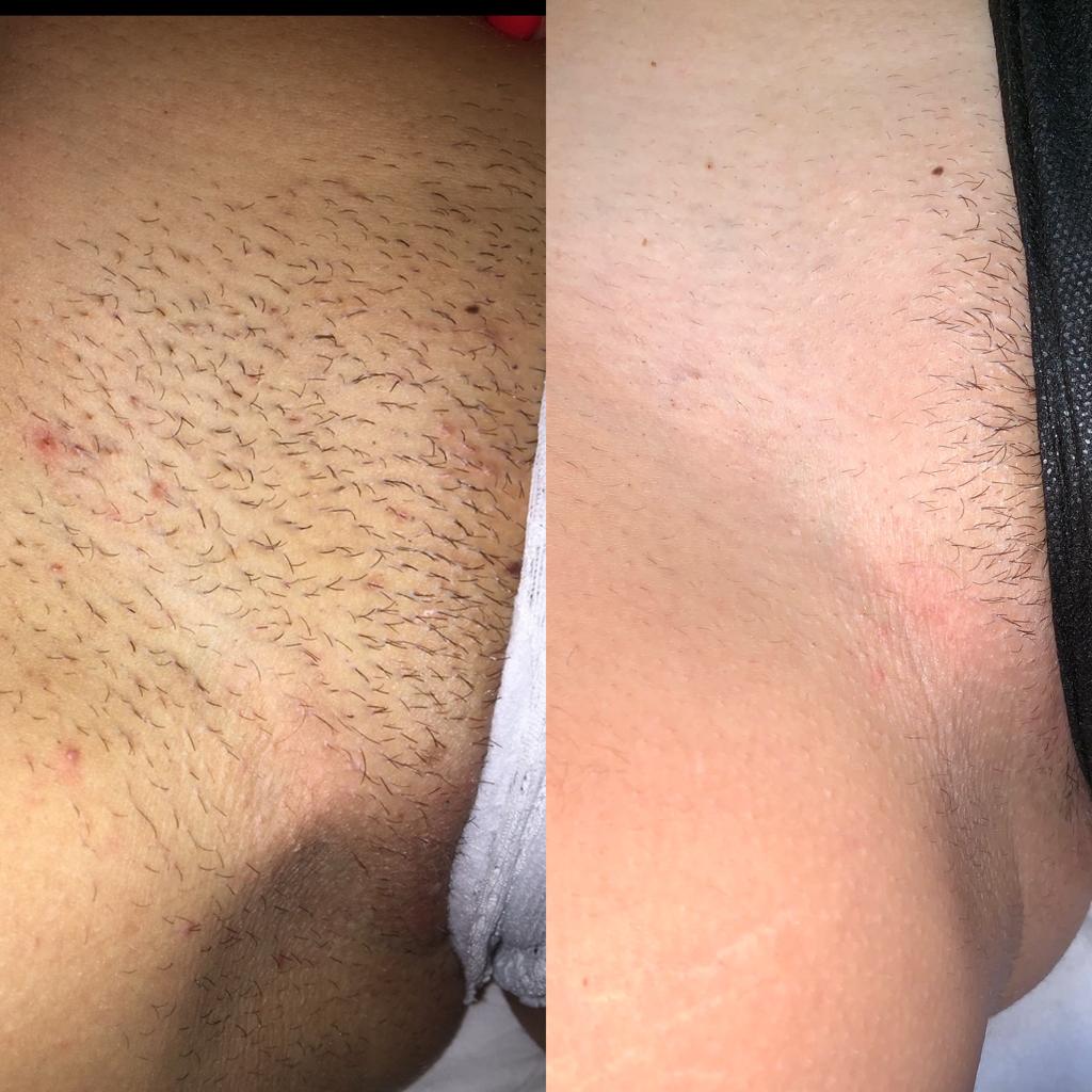 Bikini Laser Treatment at Life Holistics North East