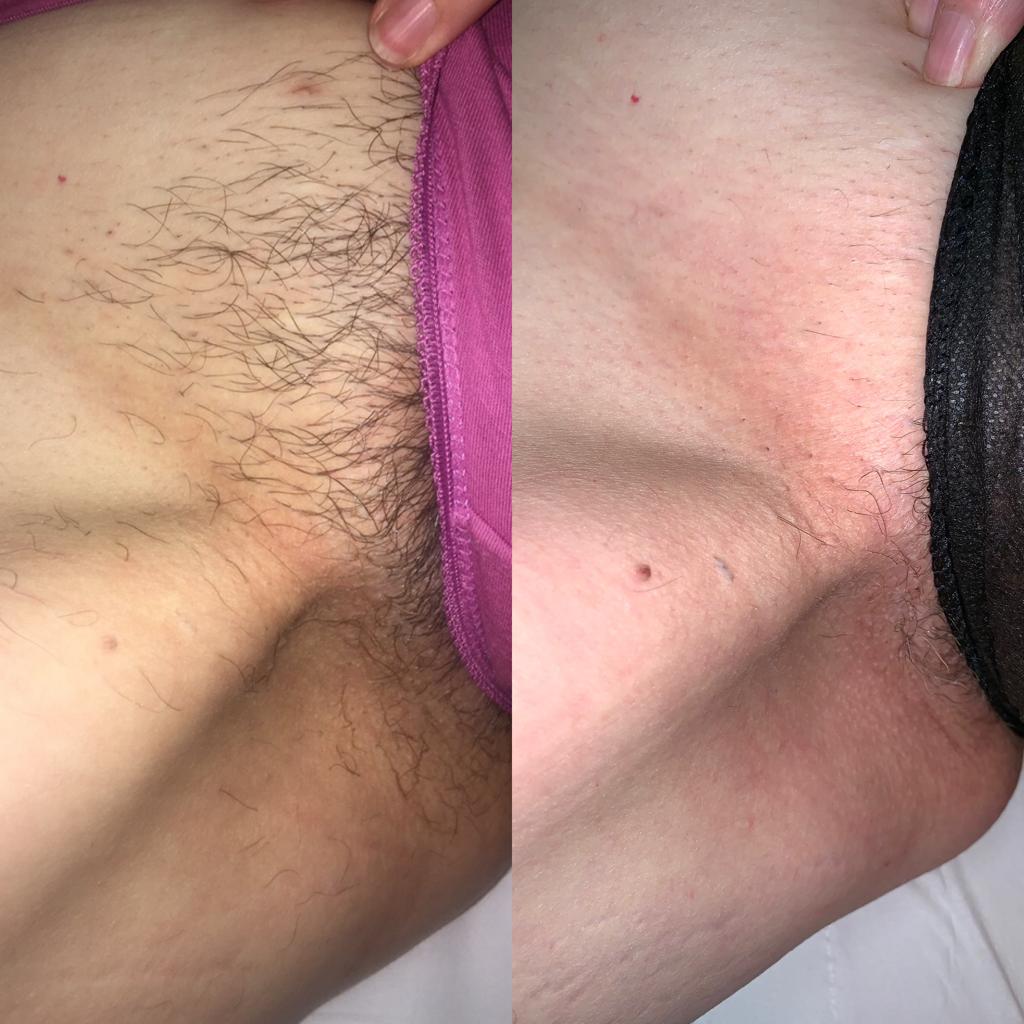 Bikini Laser Treatment at Life Holistics North East