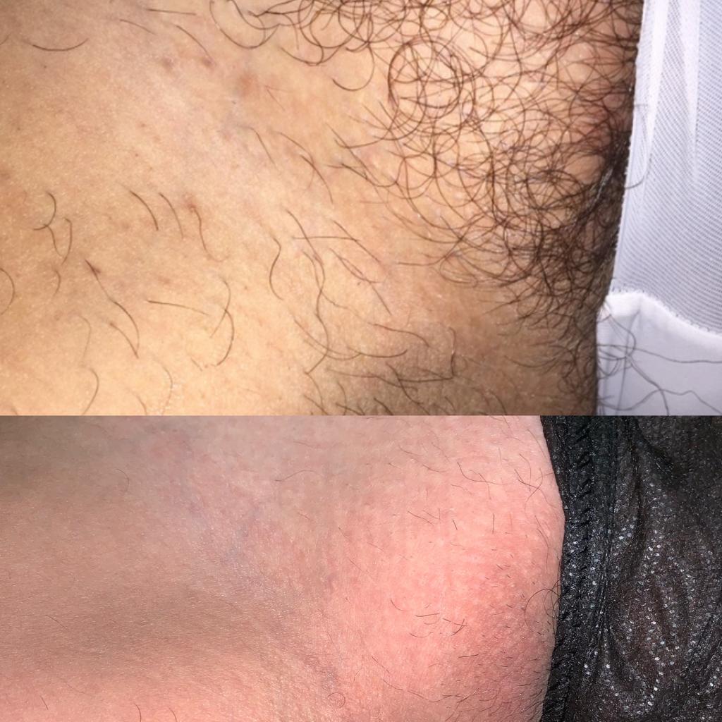 Bikini Laser Treatment at Life Holistics North East