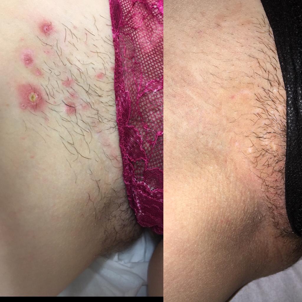 Bikini Laser Treatment at Life Holistics North East