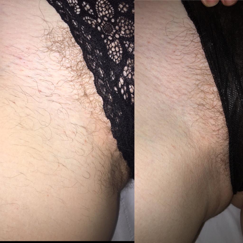 Bikini Laser Treatment at Life Holistics North East