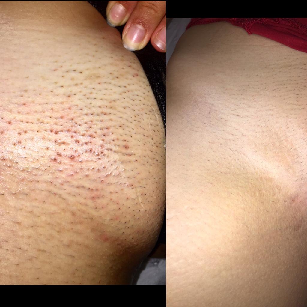 Bikini Laser Treatment at Life Holistics North East