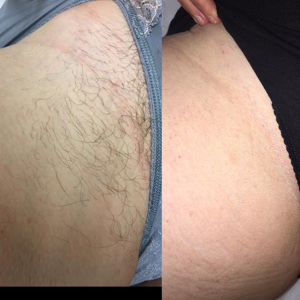 Bikini Laser Treatment at Life Holistics North East