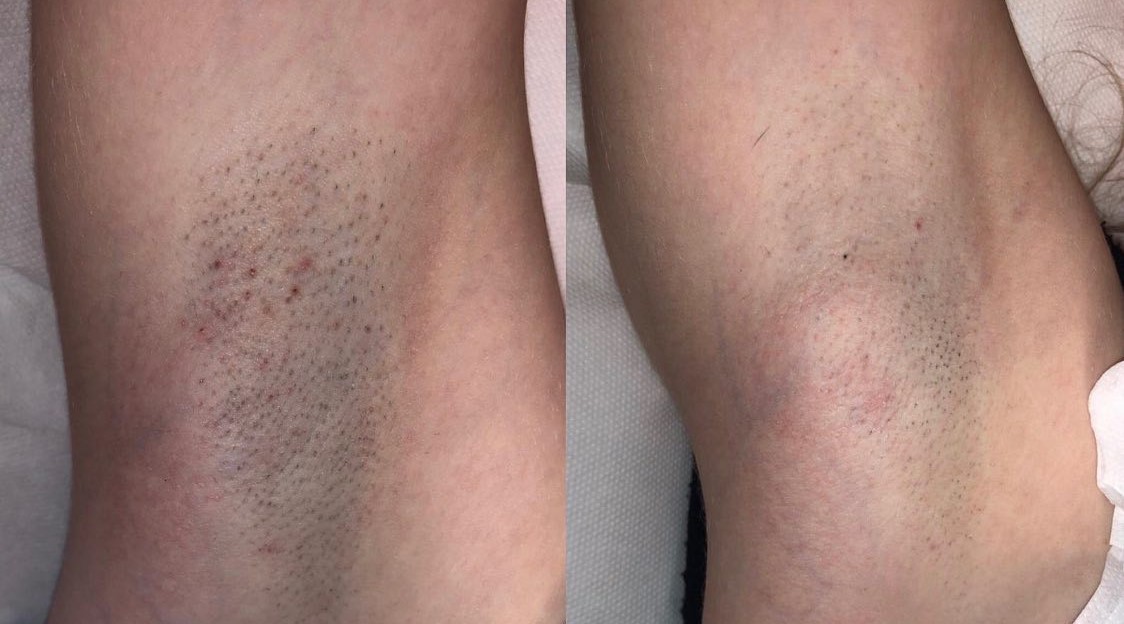 Underarms Laser Treatment at Life Holistics North East