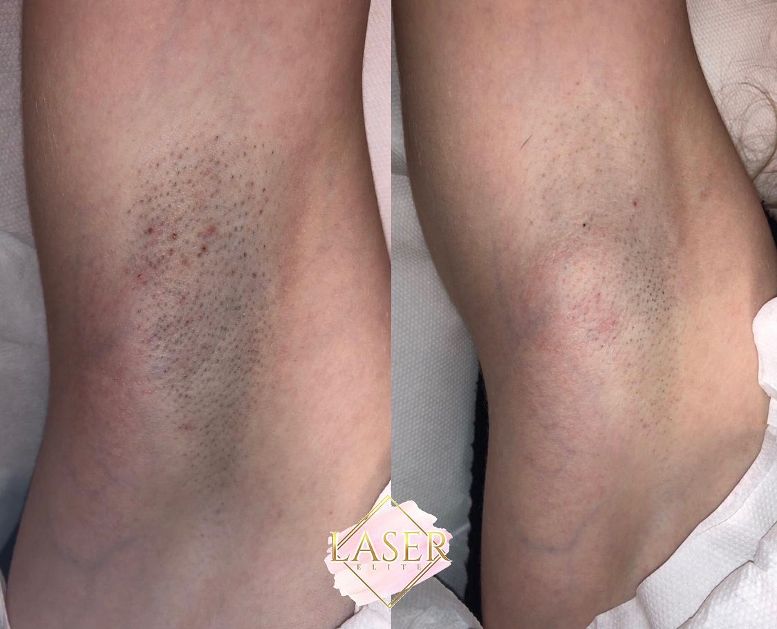Laser elite underarms Laser Treatment at Life Holistics North East