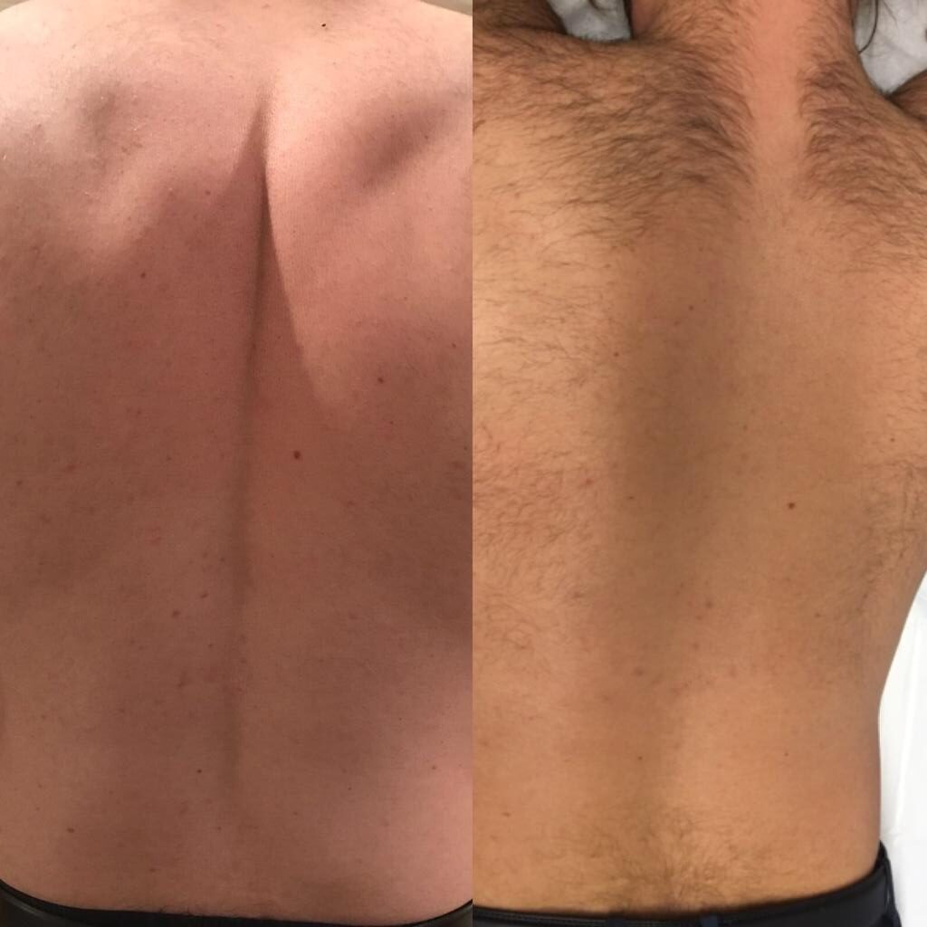 Man’s Back Laser Treatment at Life Holistics North East