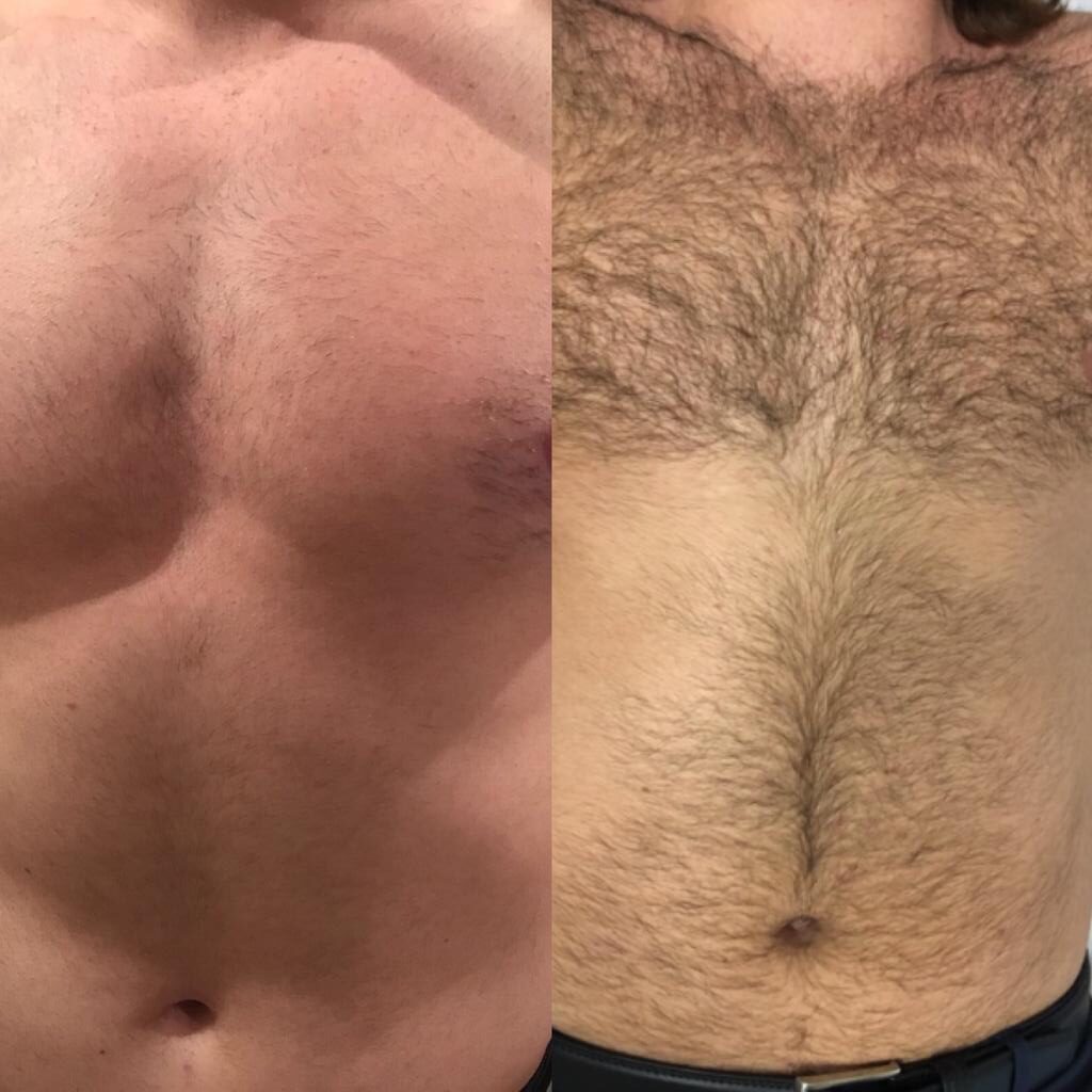 Man’s Chest Laser Treatment at Life Holistics North East