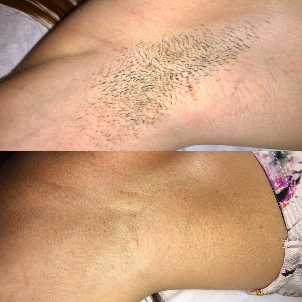 Laser Treatment at Life Holistics North East