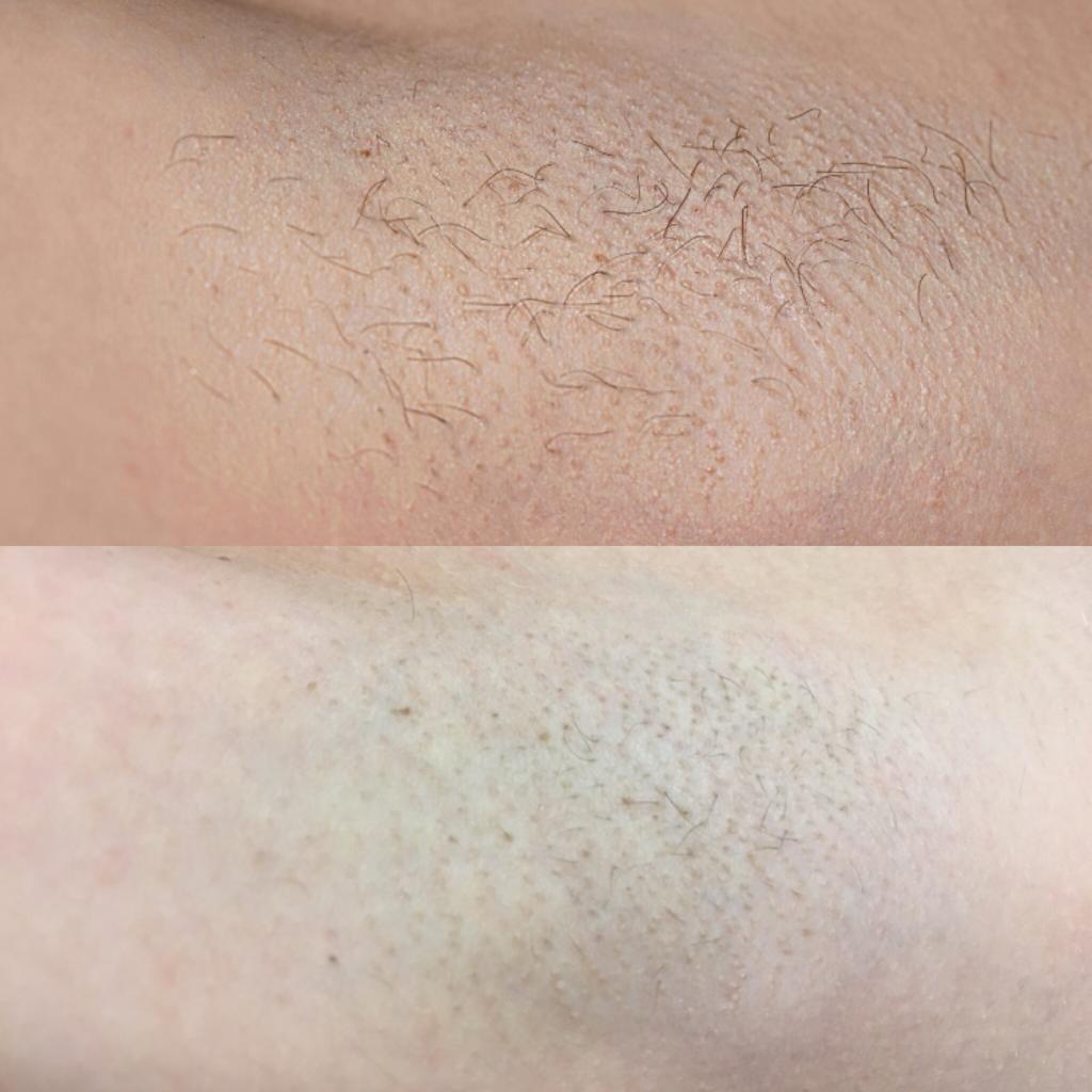 Laser Treatment at Life Holistics North East