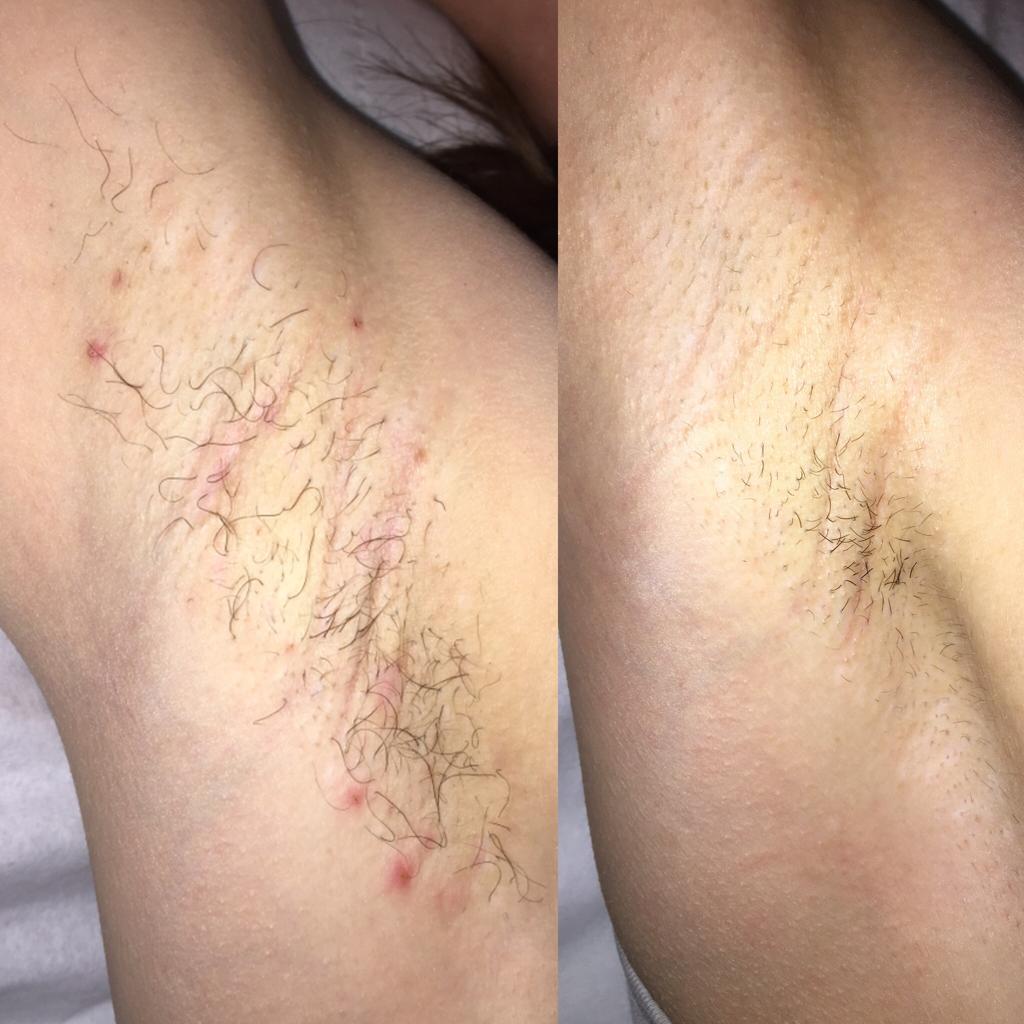 Laser Treatment at Life Holistics North East