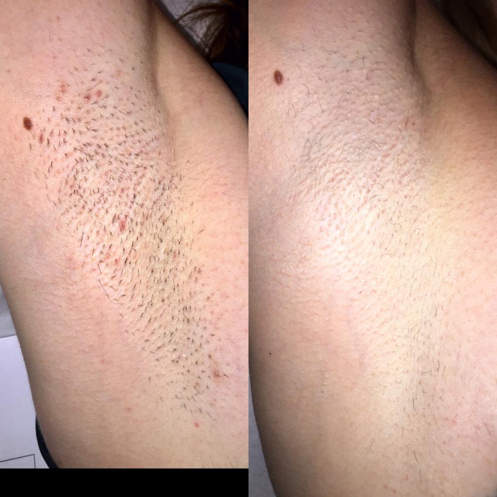 Laser Treatment at Life Holistics North East