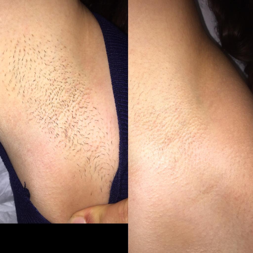 Laser Treatment at Life Holistics North East