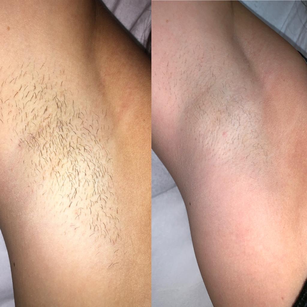 Laser Treatment at Life Holistics North East