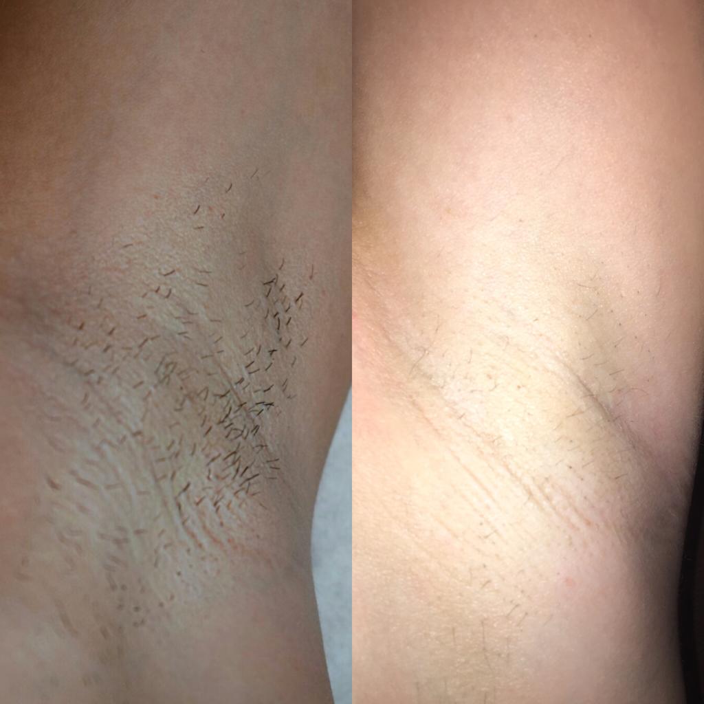 Underarm Laser Treatment at Life Holistics North East